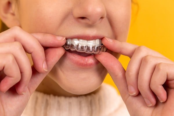Complete dentures and aligners